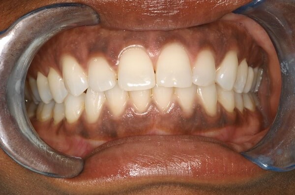 NƯỚU BỊ THÂM ĐEN THÌ PHẢI LÀM SAO? NGUYÊN NHÂN VÀ CÁCH KHẮC PHỤC - Nha Khoa  Kan Dental - Thẩm mỹ nụ cười công nghệ Mỹ